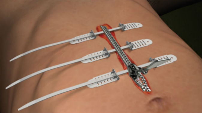 Isreali TopClosure 3s Trauma Management System